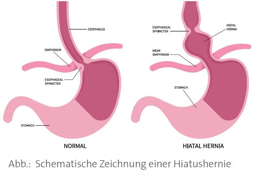 Zeichnung einer Hiatushernie mit Beschriftung